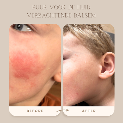 Verzachtende balsem | Voor droge & gevoelige huid
